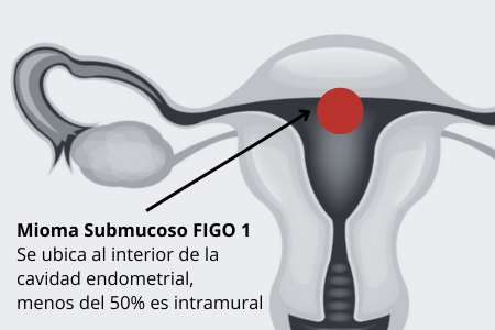 Mioma FIGO 1