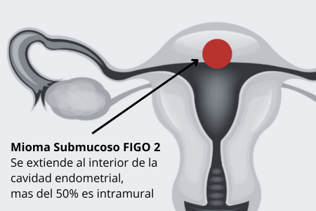 Mioma FIGO 2