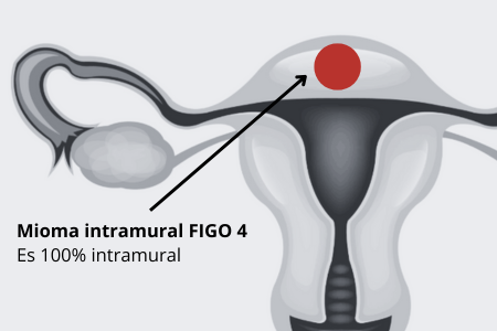 Mioma FIGO 4
