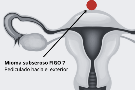 Mioma FIGO 7