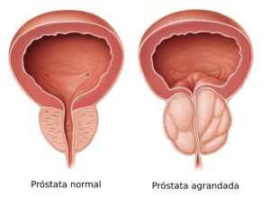 Tamaño normal de la próstata